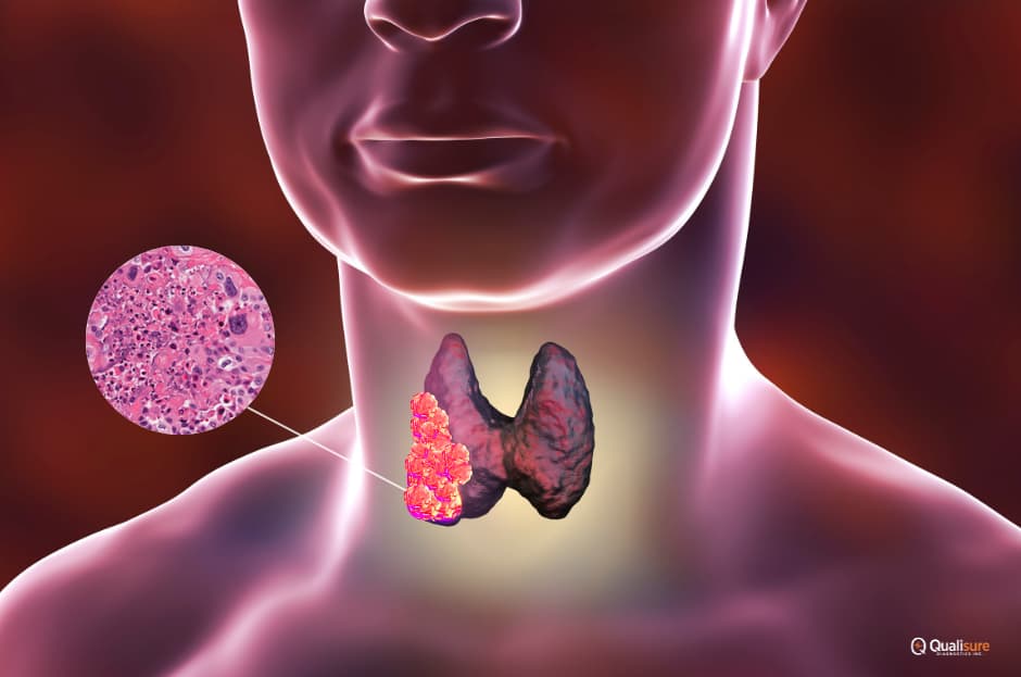 Anaplastic Thyroid Cancer
