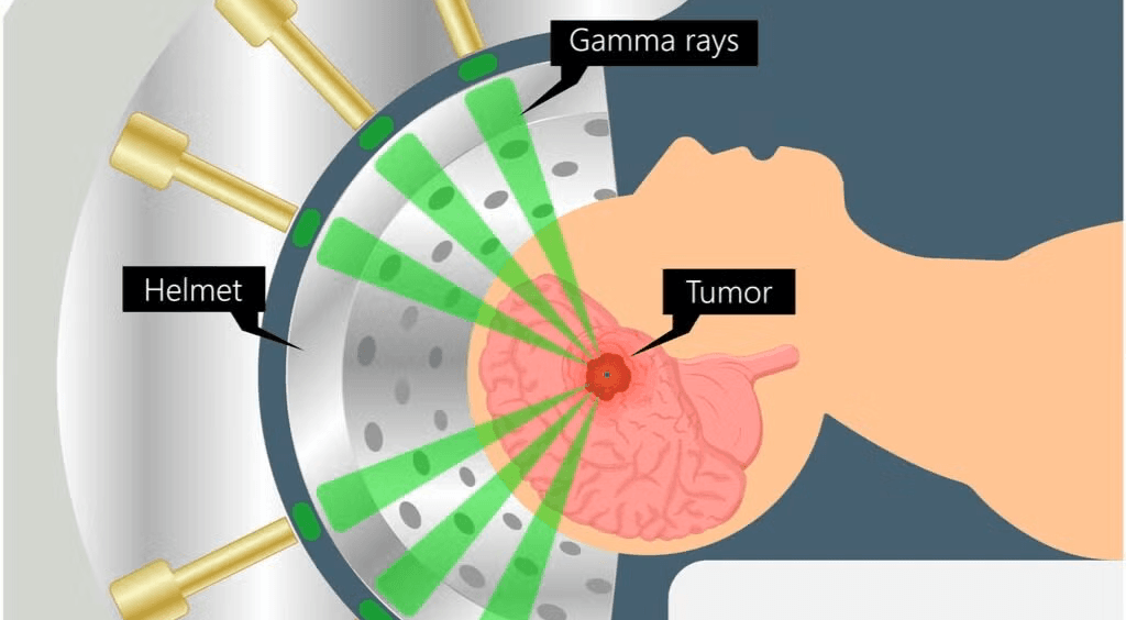 Stereotactic Radiosurgery
